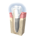 implant004