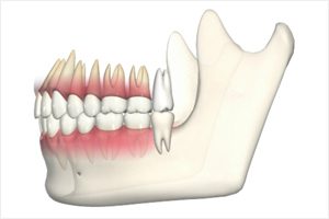 親知らずは抜いた方が良い? 親知らずは抜いた方が良い?