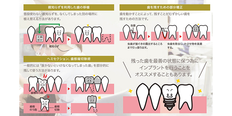 まずは歯を残す方法を検討する