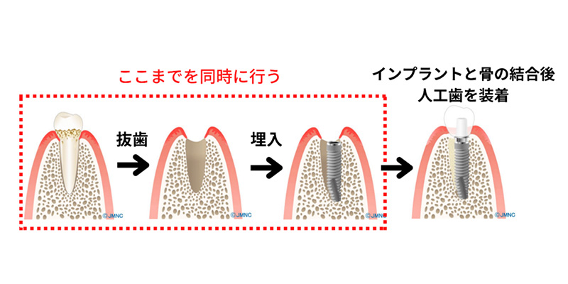 歯がない期間を無くしたい場合への対応