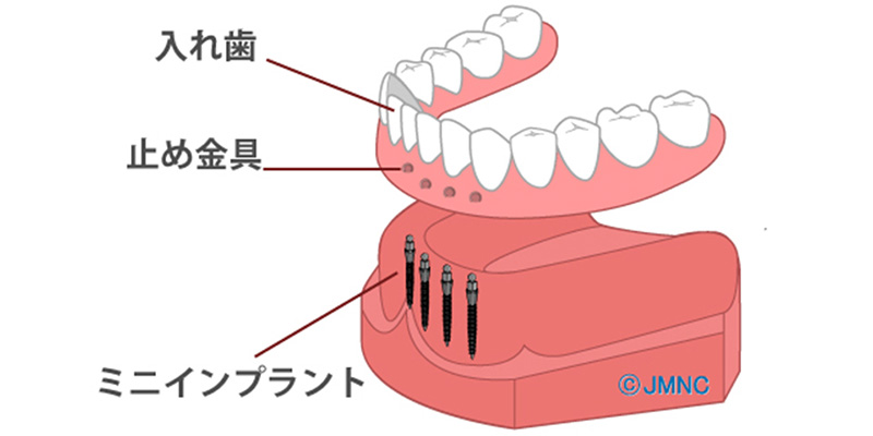 欠損の数は多いが費用を抑えたい場合への対応