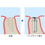 抜歯即時埋入