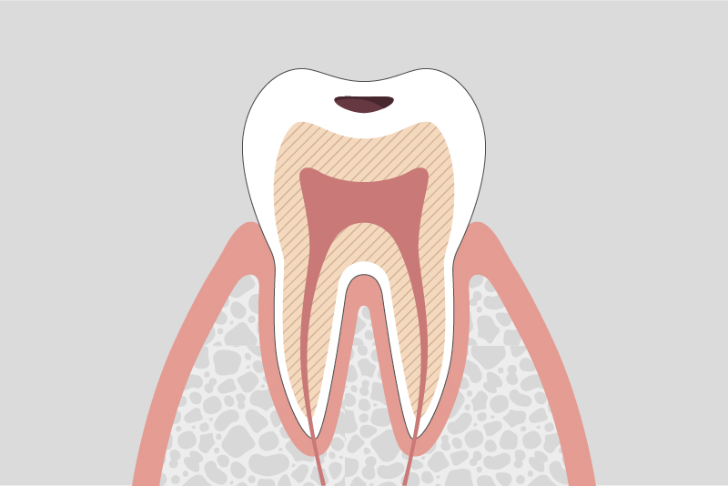 エナメル質内の虫歯