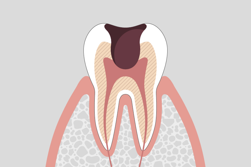 歯髄(神経)に達した虫歯