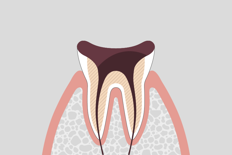 歯質が失われた虫歯