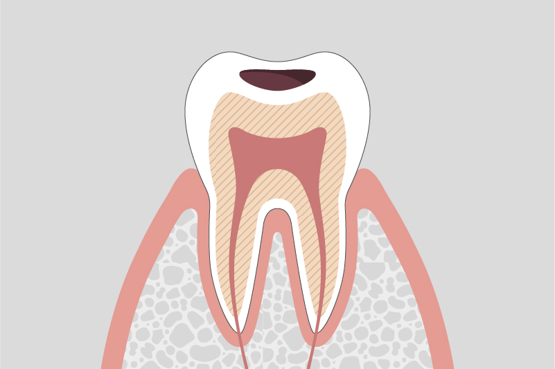 象牙質に達した虫歯