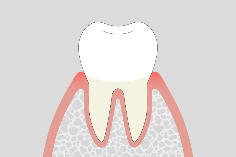 軽度歯周病（歯肉炎・軽度歯周炎）