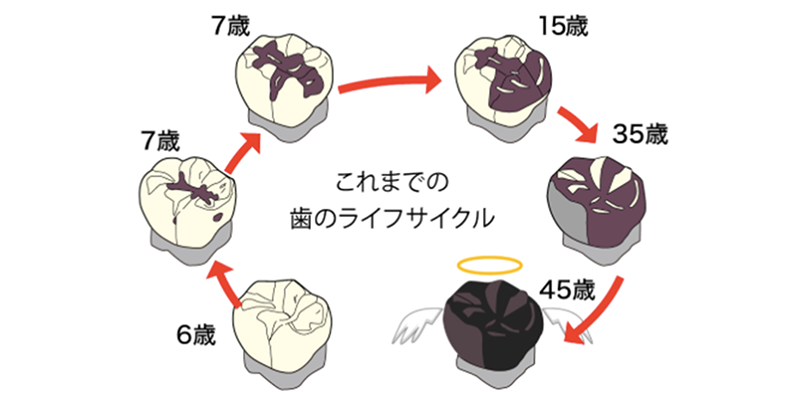 歯のライフサイク