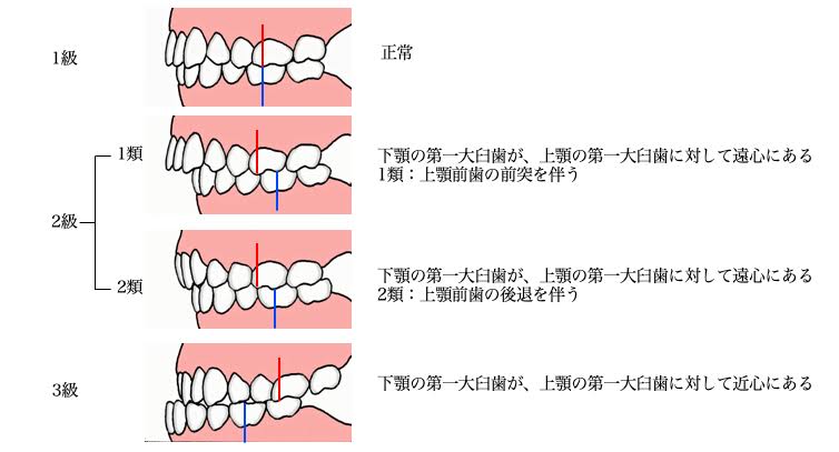 矯正を始めて苦戦したこと🤔💭