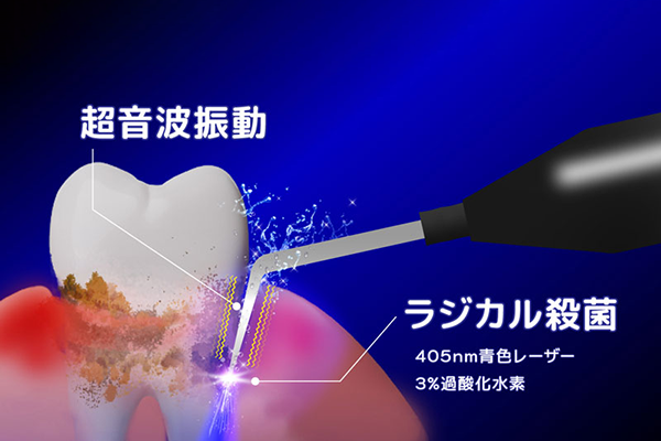 ブルーラジカル治療の特徴