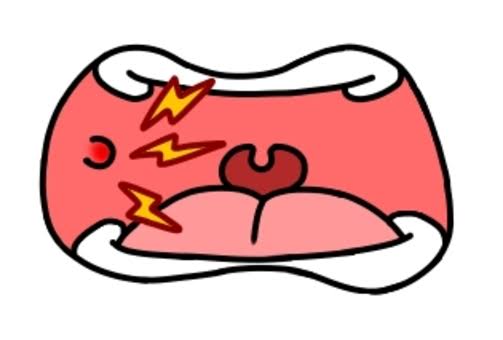 マウスピース矯正と口内炎！？🥵